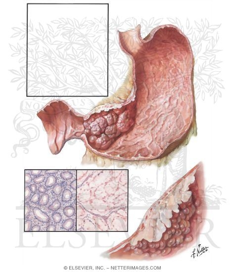 Watermarked preview of unlabeled image: Carcinoma of Stomach