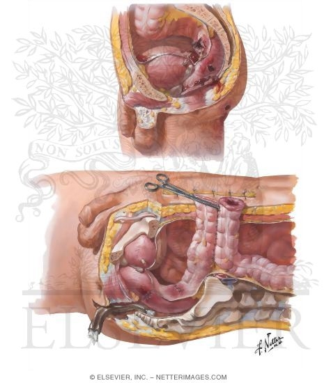 Watermarked preview of unlabeled image: Abdominal Wounds IV - Rectum
