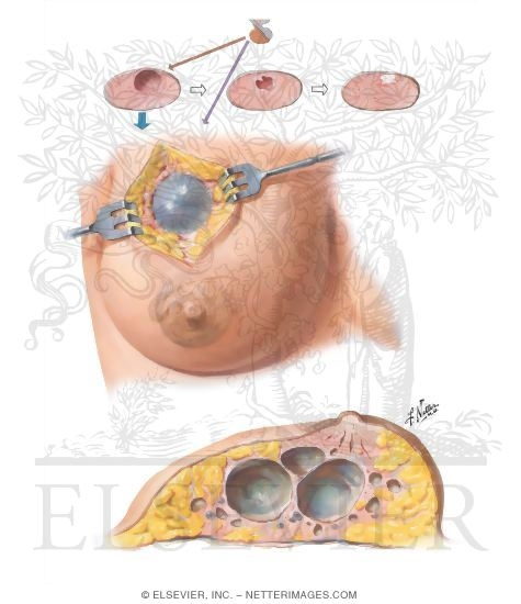 Chronic Cystic Mastitis III - Cystic Disease