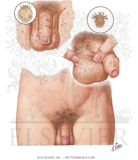 Dermatoses II - Arthropodic Origin