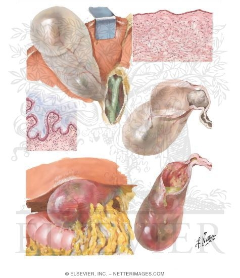 Hydrops and Empyema of Gallbladder