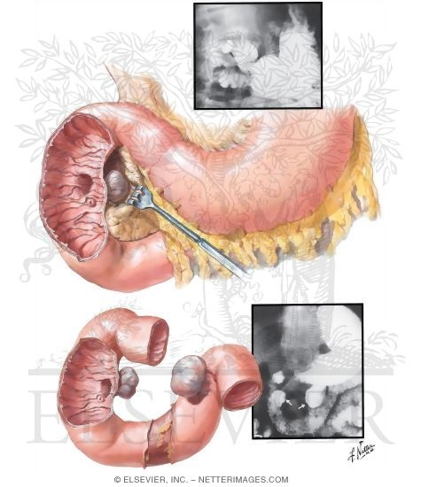 Diverticula of the Duodenum
