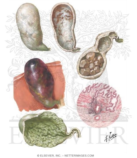 Cholecystitis II - Later Stages and Complications