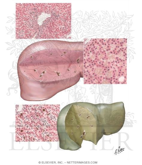 Hypoxic Conditions-Shock, Sickle Cell Anemia, Erythroblastosis