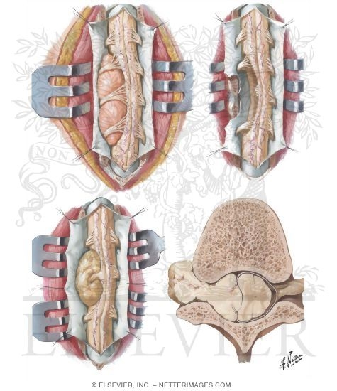 Watermarked preview of unlabeled image: Spinal Cord Tumors