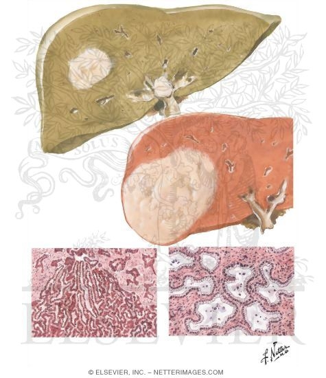 Watermarked preview of unlabeled image: Tumors IV - Bile Duct Carcinoma of Liver