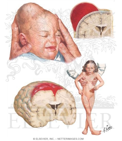 Cerebral Birth Injuries, Cephalhematoma