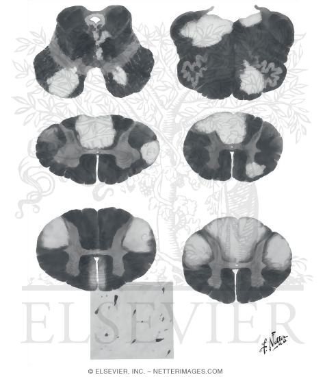 Watermarked preview of unlabeled image: Multiple Sclerosis, Amyotrophic Lateral Sclerosis and Combined Sclerosis