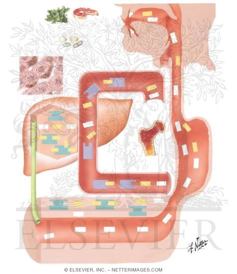 Hemosiderosis, Hemochromatosis