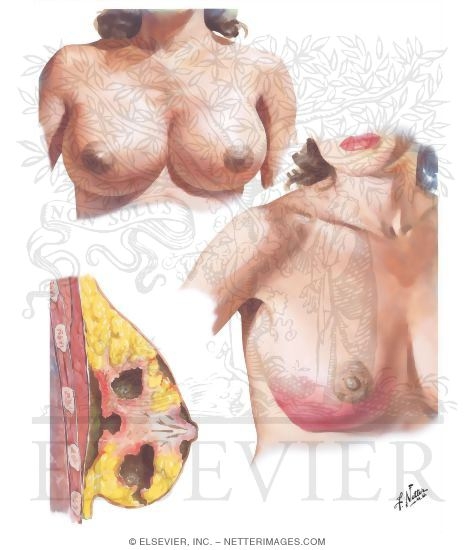 Painful Engorgement, Puerperal Mastitis