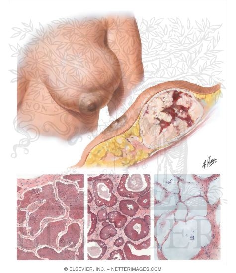 Illustration of Circumscribed Forms of Adenocarcinoma from the Netter Collection