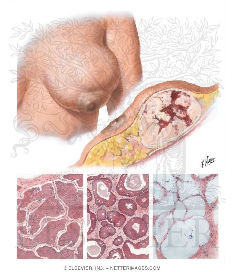 Circumscribed Forms of Adenocarcinoma