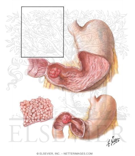 cancer gastric benign
