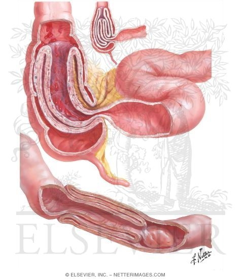 Intussusception
