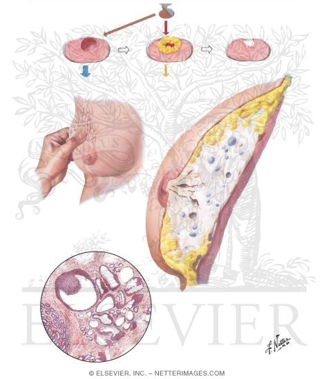 Chronic Cystic Mastitis II - Adenosis