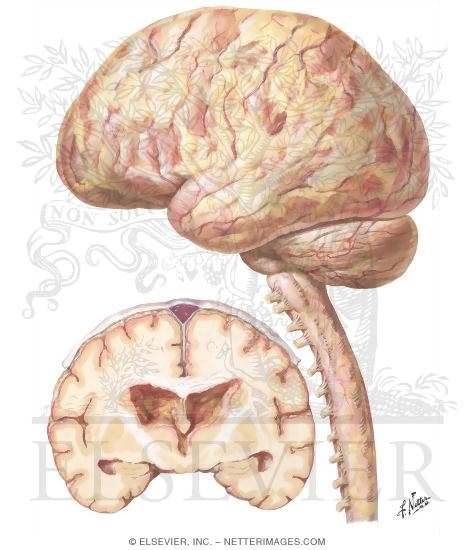 Purulent and Bacterial Meningitis