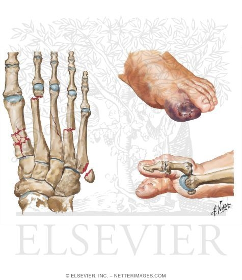 Fractures of Metatarsals, Crush Injury, and Dislocation of Great toe