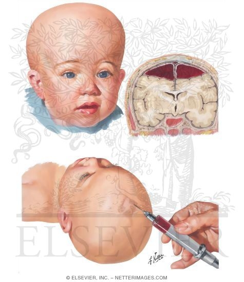 Chronic Subdural Hematoma In Infants