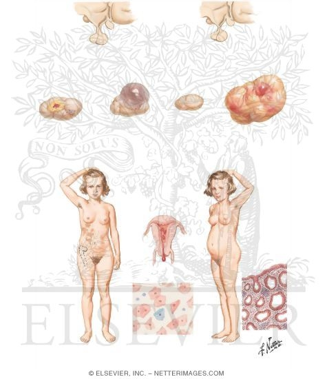 Precocious Puberty (Continued)
