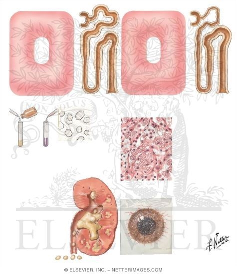 Cystinuria and Cystine Stone Disease, Cystinosis (Fanconi-Lignac Syndrome)