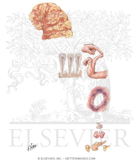 Watermarked preview of unlabeled image: Pathology and Clinical Manifestations of Hyperparathyroidism