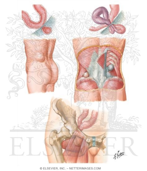 Hernia V - Lumbar and Obturator Hernias