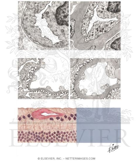 Microangiopathies