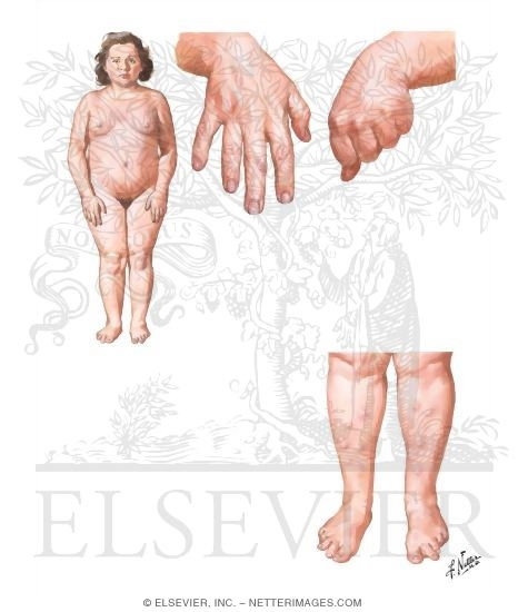 Clinical Manifestations of Pseudohypoparathyroidism Type 1a