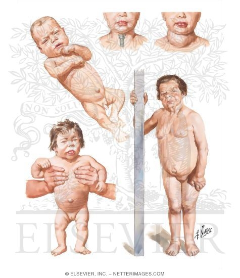 Congenital Hypothyroidism
