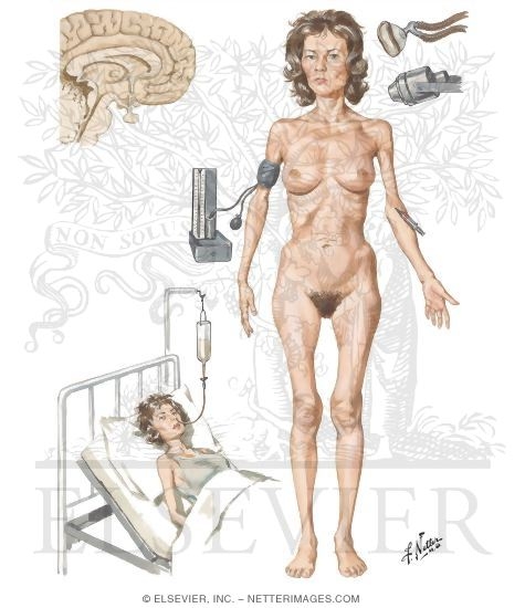 Anorexia Nervosa: A Psychoneurotic Disorder