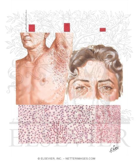 Watermarked preview of unlabeled image: Normocholesterolemic Eosinophilic Xanthomatous Granuloma