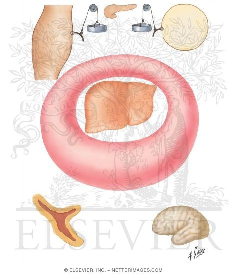 Watermarked preview of unlabeled image: Insulin Excess