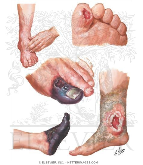 Watermarked preview of unlabeled image: Vascular Insufficiency In Diabetes
Complications of Diabetic Vasculopathy and Neuropathy