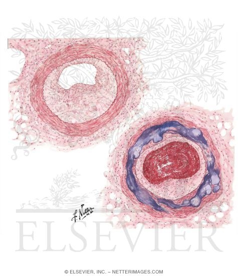 Watermarked preview of unlabeled image: Atherosclerosis in Diabetes