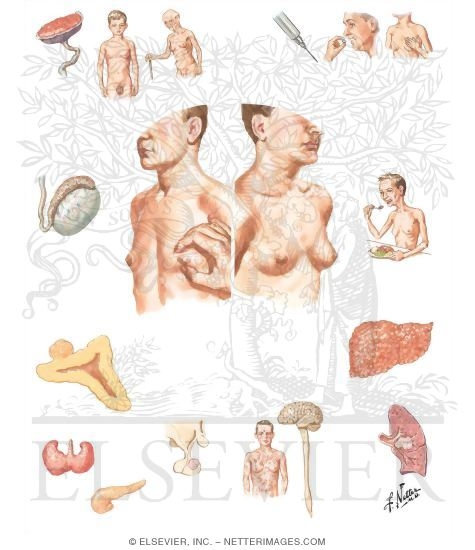 Gynecomastia