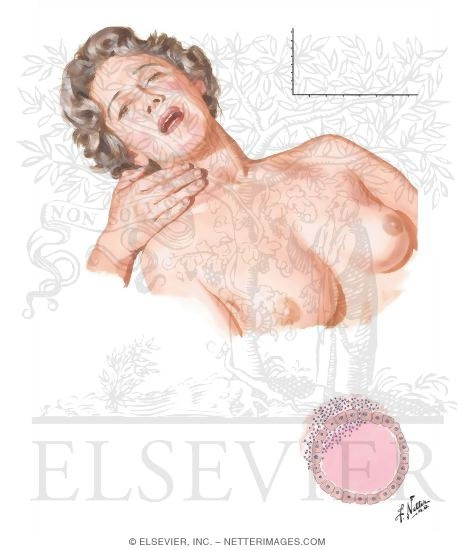 Watermarked preview of unlabeled image: Subacute Thyroiditis