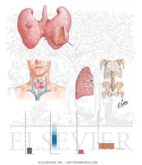 Follicular Carcinoma of the Thyroid