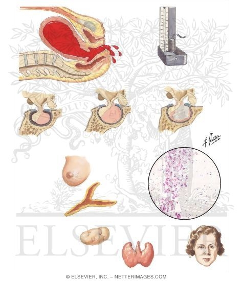 Postpartum Pituitary Necrosis
