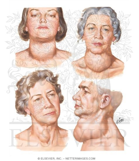 Euthyroid Goiter