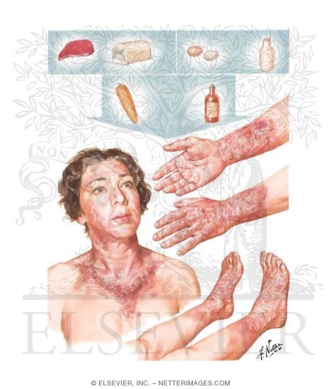 Pellagra