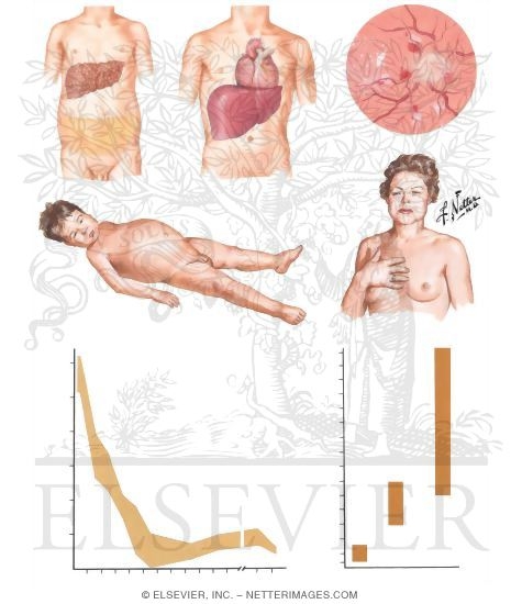 Secondary Hyperaldosteronism