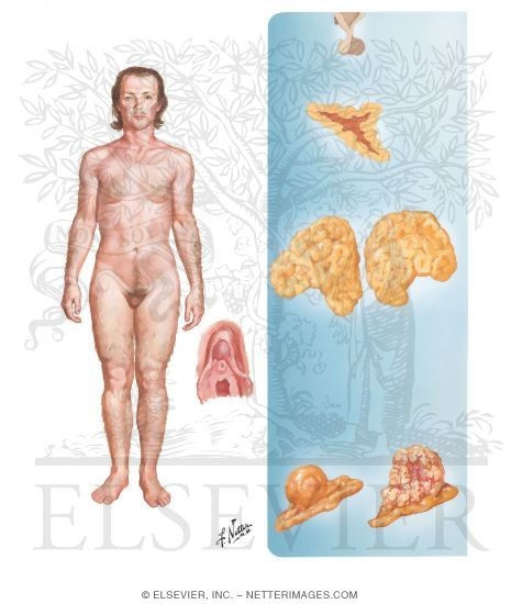 Adult Androgenital Syndromes