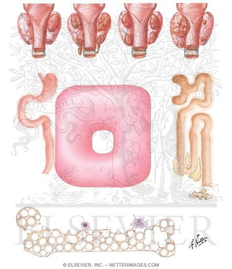 Watermarked preview of unlabeled image: Pathologic Physiology of Primary Hyperparathyroidism