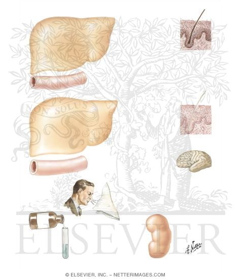 Watermarked preview of unlabeled image: Phenylketonuria (Phenylpyruvic Oligophrenia)