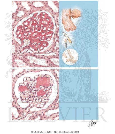 Watermarked preview of unlabeled image: Intercapillary Glomerulosclerosis