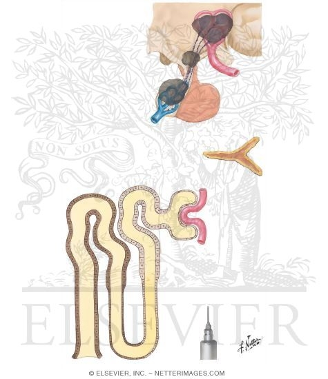 Central Diabetes Insipidus