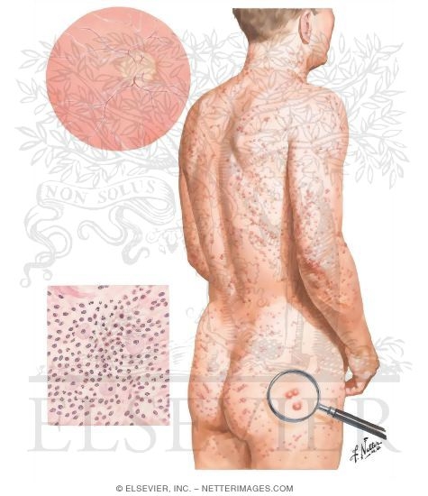 Watermarked preview of unlabeled image: Clinical Manifestations of Hypertriglyceridemia (Continued)