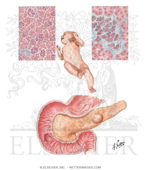 Watermarked preview of unlabeled image: Primary Pancreatic b-Cell Hyperplasia