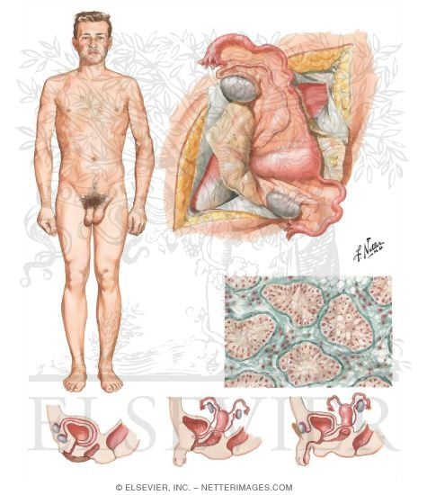Watermarked preview of unlabeled image: Disorders of Sex Differentiation