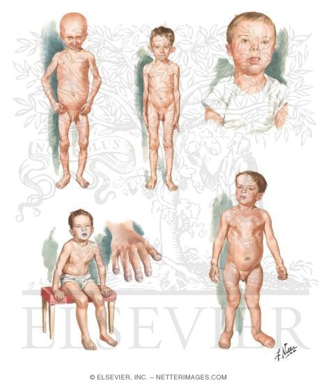 Growth and Dwarfism